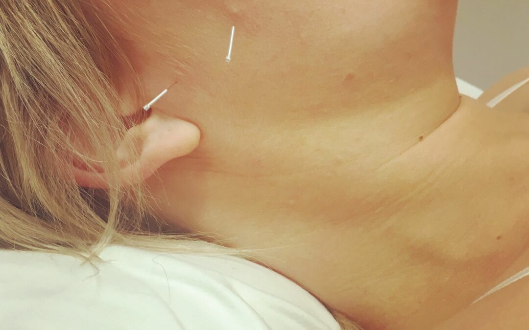 Could dry needling be the answer to your aches and pains?